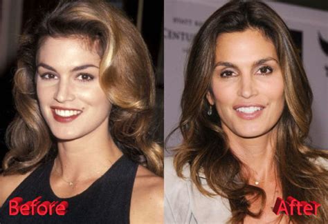 Cindy Crawford Before and After Plastic Surgery